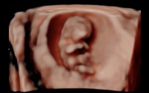 non-diagnostic pregnancy scan at bump baby imaging matiland