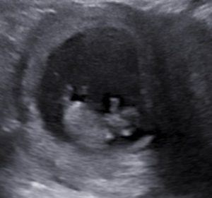 before and after image of 2D/3D/4D/5D Ultrasound scan