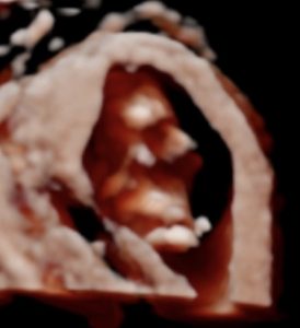before and after image of 2D/3D/4D/5D Ultrasound scan