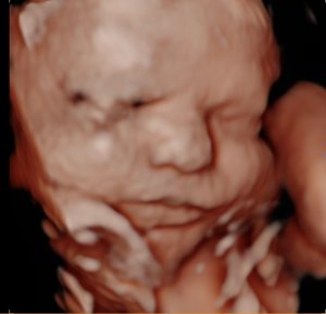 3D/4D/5D Pregnancy Ultrasound & Gender Reveal