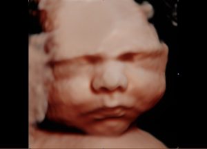 Bump Baby Imaging - Gender and 2D/3D/4D/5D Ultrasound Packages