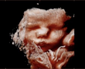 Bump Baby Imaging - Gender and 2D/3D/4D/5D Ultrasound Packages
