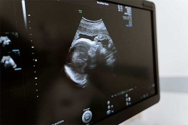 3D/4D/5D Pregnancy Ultrasound & Gender Reveal